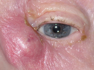 What is the treatment for clogged tear ducts in adults?