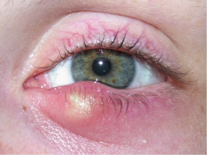 Eyelid Infections - Warwar Eye Group
