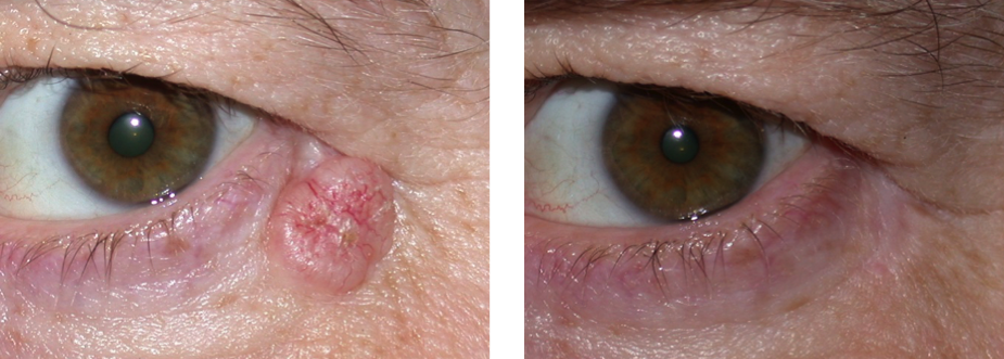 Eyelid Basal Cell Carcinoma - Warwar Eye Group